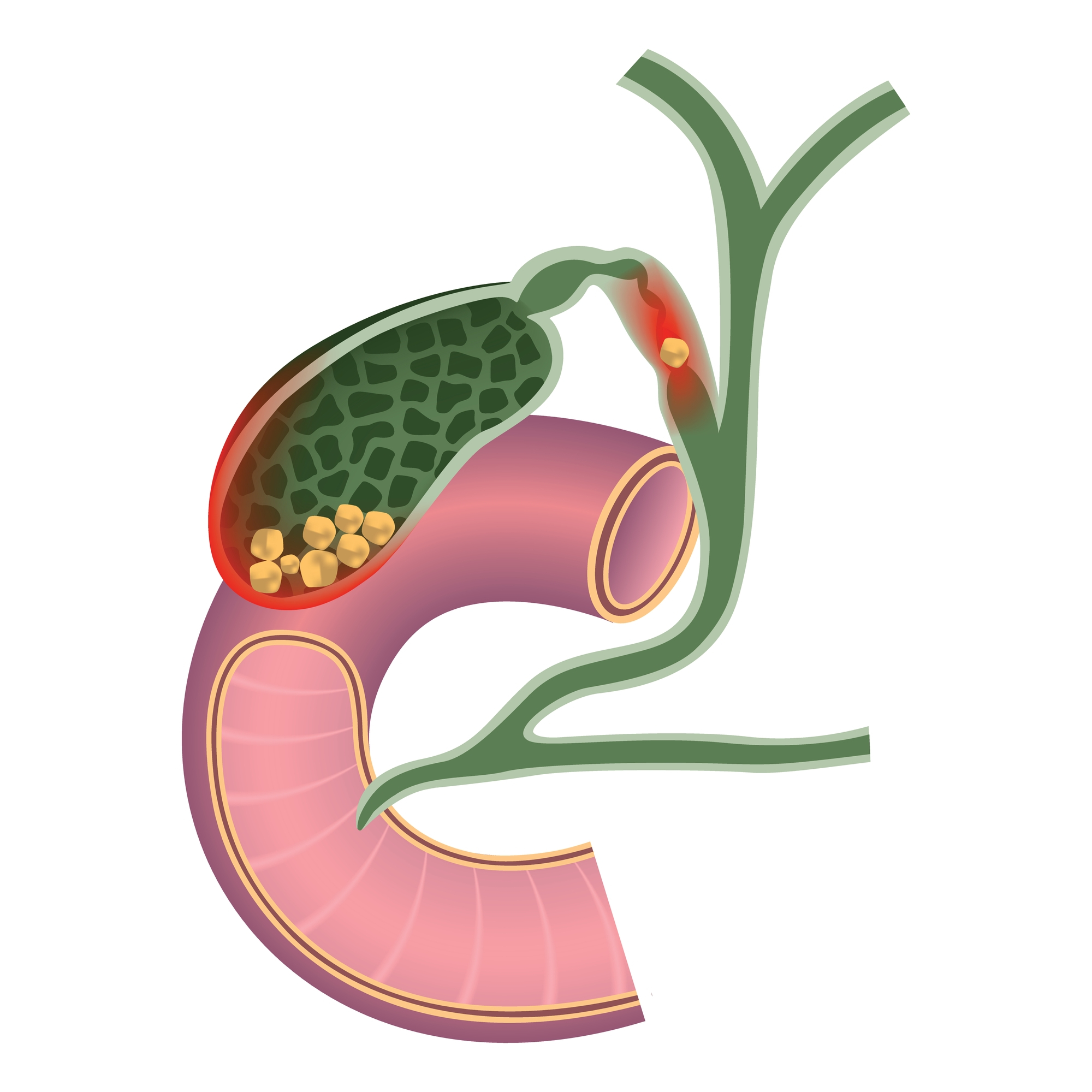 Minimally Invasive Gallbladder Surgery